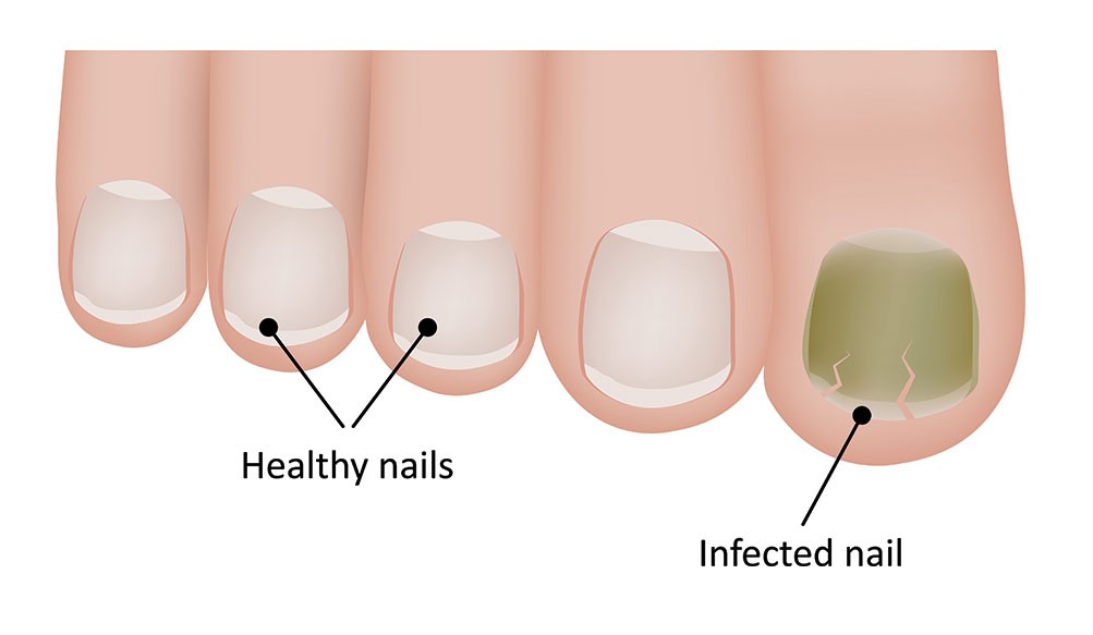 Most Effective Nail Fungus Treatment During Pregnancy | GNFO