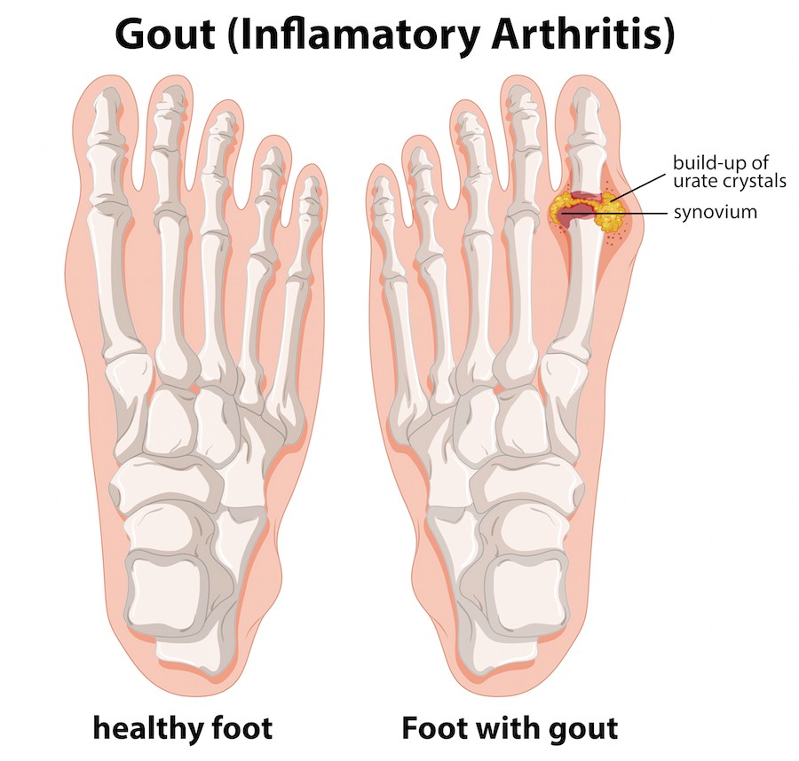 Diagram explanation of Gout in human foot illustration
