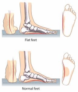 flat feet vs normal feet diagram